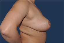 Breast Reduction After Photo by Jerry Weiger Chang, MD, FACS; Flushing, NY - Case 44886