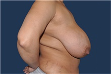 Breast Reduction Before Photo by Jerry Weiger Chang, MD, FACS; Flushing, NY - Case 44886