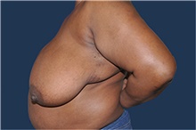 Breast Reconstruction Before Photo by Jerry Weiger Chang, MD, FACS; Flushing, NY - Case 44887