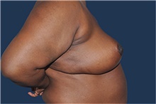Breast Reconstruction After Photo by Jerry Weiger Chang, MD, FACS; Flushing, NY - Case 44887