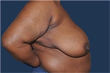 Breast Reconstruction Before Photo by Jerry Weiger Chang, MD, FACS; Flushing, NY - Case 44887
