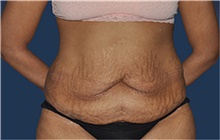 Tummy Tuck Before Photo by Jerry Weiger Chang, MD, FACS; Flushing, NY - Case 44888