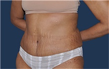 Tummy Tuck After Photo by Jerry Weiger Chang, MD, FACS; Flushing, NY - Case 44888