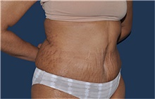 Tummy Tuck After Photo by Jerry Weiger Chang, MD, FACS; Flushing, NY - Case 44888