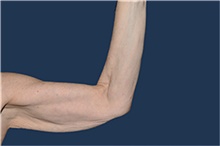 Arm Lift Before Photo by Jerry Weiger Chang, MD, FACS; Flushing, NY - Case 44889