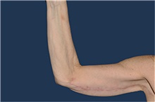 Arm Lift After Photo by Jerry Weiger Chang, MD, FACS; Flushing, NY - Case 44889