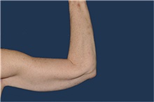 Arm Lift After Photo by Jerry Weiger Chang, MD, FACS; Flushing, NY - Case 44889