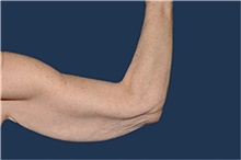 Arm Lift Before Photo by Jerry Weiger Chang, MD, FACS; Flushing, NY - Case 44889