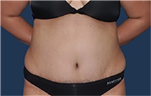 Liposuction After Photo by Jerry Weiger Chang, MD, FACS; Flushing, NY - Case 44890