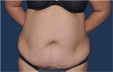 Liposuction Before Photo by Jerry Weiger Chang, MD, FACS; Flushing, NY - Case 44890