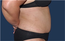 Liposuction After Photo by Jerry Weiger Chang, MD, FACS; Flushing, NY - Case 44890