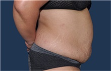 Liposuction Before Photo by Jerry Weiger Chang, MD, FACS; Flushing, NY - Case 44890