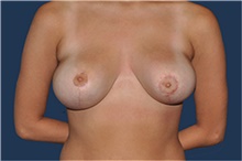 Breast Reduction After Photo by Jerry Weiger Chang, MD, FACS; Flushing, NY - Case 44892