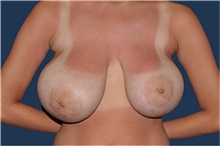 Breast Reduction Before Photo by Jerry Weiger Chang, MD, FACS; Flushing, NY - Case 44892