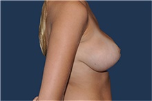 Breast Reduction After Photo by Jerry Weiger Chang, MD, FACS; Flushing, NY - Case 44892