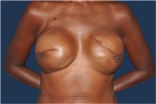 Breast Reconstruction After Photo by Jerry Weiger Chang, MD, FACS; Flushing, NY - Case 44893