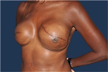 Breast Reconstruction After Photo by Jerry Weiger Chang, MD, FACS; Flushing, NY - Case 44893
