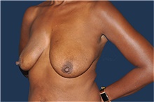 Breast Reconstruction Before Photo by Jerry Weiger Chang, MD, FACS; Flushing, NY - Case 44893