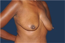Breast Reconstruction Before Photo by Jerry Weiger Chang, MD, FACS; Flushing, NY - Case 44893