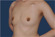 Breast Reconstruction Before Photo by Jerry Weiger Chang, MD, FACS; Flushing, NY - Case 44894