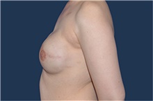 Breast Reconstruction After Photo by Jerry Weiger Chang, MD, FACS; Flushing, NY - Case 44894