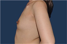 Breast Reconstruction Before Photo by Jerry Weiger Chang, MD, FACS; Flushing, NY - Case 44894