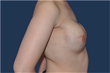 Breast Reconstruction After Photo by Jerry Weiger Chang, MD, FACS; Flushing, NY - Case 44894