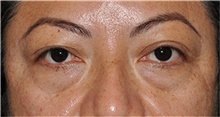 Eyelid Surgery Before Photo by Jerry Weiger Chang, MD, FACS; Flushing, NY - Case 44895