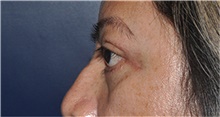 Eyelid Surgery After Photo by Jerry Weiger Chang, MD, FACS; Flushing, NY - Case 44895