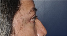 Eyelid Surgery After Photo by Jerry Weiger Chang, MD, FACS; Flushing, NY - Case 44895