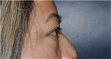 Eyelid Surgery Before Photo by Jerry Weiger Chang, MD, FACS; Flushing, NY - Case 44895
