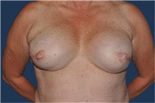 Breast Reconstruction After Photo by Jerry Weiger Chang, MD, FACS; Flushing, NY - Case 44896