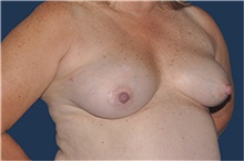 Breast Reconstruction Before Photo by Jerry Weiger Chang, MD, FACS; Flushing, NY - Case 44896