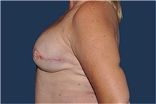 Breast Reconstruction After Photo by Jerry Weiger Chang, MD, FACS; Flushing, NY - Case 44896
