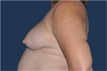 Breast Reconstruction Before Photo by Jerry Weiger Chang, MD, FACS; Flushing, NY - Case 44896