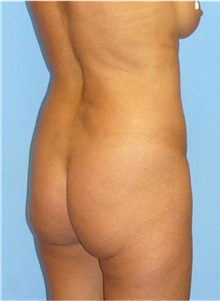 Buttock Lift with Augmentation Before Photo by Siamak Agha, MD PhD FACS; Newport Beach, CA - Case 43807