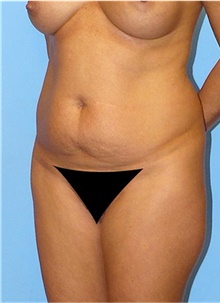 Buttock Lift with Augmentation Before Photo by Siamak Agha, MD PhD FACS; Newport Beach, CA - Case 43807
