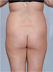 Buttock Lift with Augmentation Before Photo by Siamak Agha, MD PhD FACS; Newport Beach, CA - Case 43808