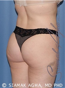 Buttock Lift with Augmentation After Photo by Siamak Agha, MD PhD FACS; Newport Beach, CA - Case 43808