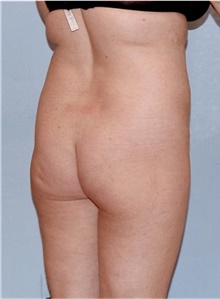 Buttock Lift with Augmentation Before Photo by Siamak Agha, MD PhD FACS; Newport Beach, CA - Case 43808