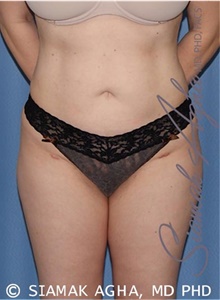 Buttock Lift with Augmentation After Photo by Siamak Agha, MD PhD FACS; Newport Beach, CA - Case 43808