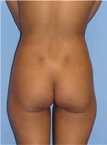 Buttock Lift with Augmentation Before Photo by Siamak Agha, MD PhD FACS; Newport Beach, CA - Case 43809