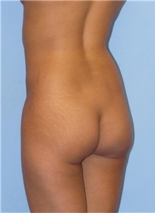 Buttock Lift with Augmentation Before Photo by Siamak Agha, MD PhD FACS; Newport Beach, CA - Case 43809