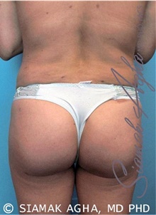 Buttock Lift with Augmentation After Photo by Siamak Agha, MD PhD FACS; Newport Beach, CA - Case 43810