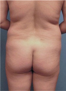 Buttock Lift with Augmentation Before Photo by Siamak Agha, MD PhD FACS; Newport Beach, CA - Case 43810