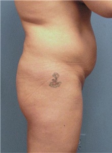 Buttock Lift with Augmentation Before Photo by Siamak Agha, MD PhD FACS; Newport Beach, CA - Case 43810
