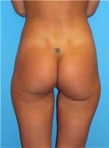 Buttock Lift with Augmentation Before Photo by Siamak Agha, MD PhD FACS; Newport Beach, CA - Case 43811