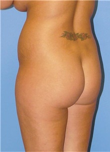 Buttock Lift with Augmentation Before Photo by Siamak Agha, MD PhD FACS; Newport Beach, CA - Case 43812