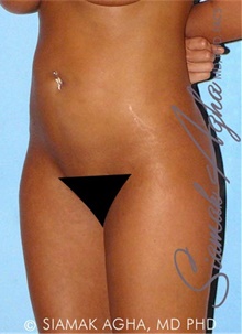 Buttock Lift with Augmentation After Photo by Siamak Agha, MD PhD FACS; Newport Beach, CA - Case 43812