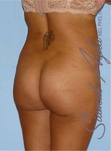 Buttock Lift with Augmentation After Photo by Siamak Agha, MD PhD FACS; Newport Beach, CA - Case 43813